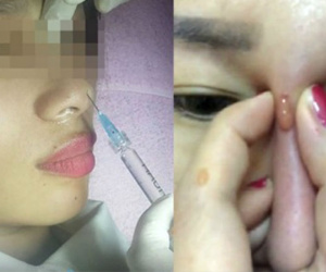 Vì sao tiêm filler nâng mũi lại bị mù mắt?