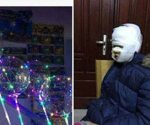 Bé trai bị bỏng hết phần mặt do bóng bay Galaxy bơm khí Hydro phát nổ?