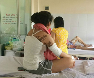 Bị bạn trai cũ tạt axit khi có người tình mới