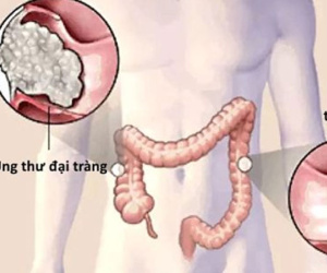Bao lâu nên nội soi kiểm tra ung thư đại trực tràng?