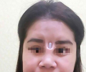 Bị thanh silicone đâm thủng mũi chòi ra giữa mặt