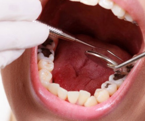 7 cách chữa sâu răng tại nhà hiệu quả