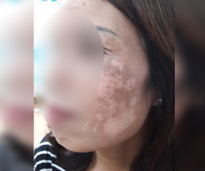 Hà Nội: Dùng kem trộn, một phụ nữ bị 'lột sạch' da mặt, mất hàng trăm triệu điều trị nhưng chỉ phục hồi được 30-40%