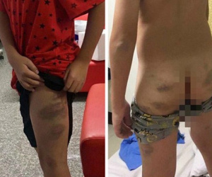 Thi không đạt 95 điểm, bé trai bị mẹ đánh đập dã man khiến toàn thân bầm tím