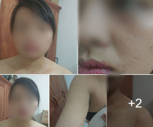 Hà Nội: Từ chối nộp hết tiền kiếm được hàng tháng cho mẹ chồng, người phụ nữ bị nhà chồng đánh thâm tím khắp người