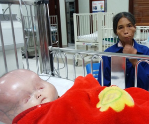 Vụ bé trai có cái đầu to khác lạ bị bố bỏ mẹ con đi lấy vợ khác: Tiên lượng xấu, gia đình xin về