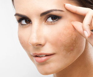 Những lưu ý cực kỳ quan trọng cho làn da bị nám, ai không biết sẽ tiếc hùi hụi!