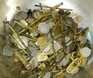 Người đàn ông có 263 đồng xu và 100 móng tay trong bụng