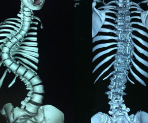 Thiếu nữ có cột sống uốn lượn như xương rắn