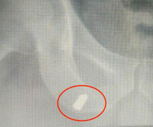 Đạn lạc găm trúng đùi người đi làm ruộng ở Nghệ An
