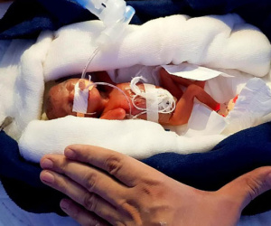 Bé gái sinh ra nhỏ xíu chưa bằng bàn tay, bác sĩ không dám tiên lượng điều gì thì 6 tháng điều kỳ diệu đã xảy ra