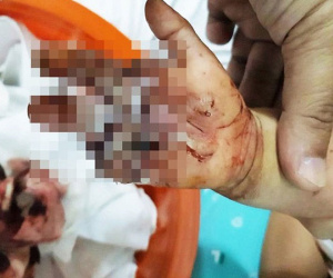 Bình Dương: Bé trai 2 tuổi bị sên xe máy quấn đứt lìa bàn tay