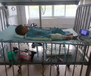 Ngã vào nồi bỗng rượu đang sôi, bé 3 tuổi nguy kịch