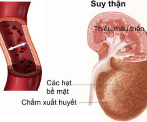 Bệnh thận ảnh hưởng tới tình dục thế nào?