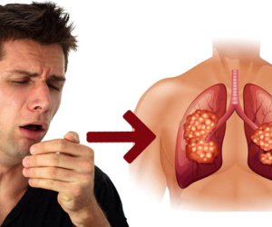 Ho trong bao lâu thì bạn nên đi khám để phòng ngừa bệnh ung thư phổi?
