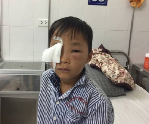 Bé trai 8 tuổi bị chó cắn thủng mắt, bố mẹ nhìn thấy nhưng không kịp trở tay