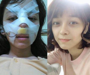 Trải nghiệm kinh hoàng của cô gái trẻ lần đầu nâng mũi sẽ khiến nhiều người nghĩ lại nếu định 'dao kéo'