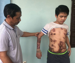 Cậu bé 16 tuổi sống sót sau vụ cháy xưởng bánh kẹo khiến 8 người tử vong ở Hà Nội bây giờ ra sao