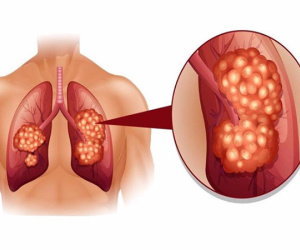Phát hiện sớm ung thư phổi nhờ xét nghiệm máu