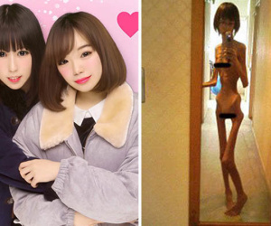 Sốc: Cô gái trẻ thân hình gầy xác ve vì bị ông nội bỏ đói