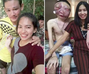 Dù chồng bị ung thư với khuôn mặt biến dạng, vợ vẫn một lòng ở bên chăm sóc: '3 năm, em vẫn yêu anh như ngày đầu'