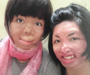 2 người phụ nữ bị chồng tẩm xăng đốt 'nắm tay' nhau tô hồng cuộc sống
