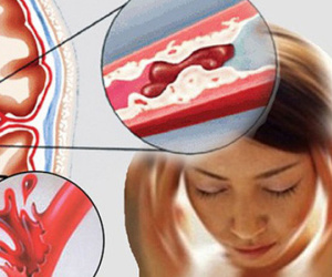 4 quy tắc nhận diện nhanh người bị tai biến mạch máu não