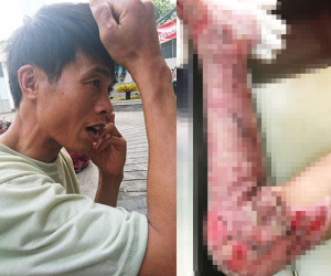 Thương tâm cha lóc da cứu con trai 3 tuổi bỏng toàn bộ cơ thể vì cháy nhà