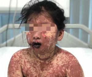 Dùng thuốc ở phòng khám tư, cháu bé 7 tuổi bị bỏng toàn thân