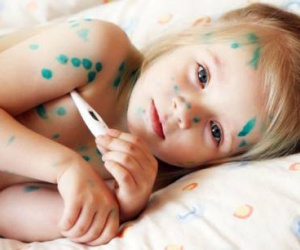 Cẩn trọng nhiễm trùng máu khi tùy tiện dùng Đông y trị thủy đậu