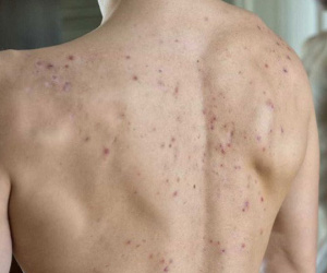 Mọc mụn trứng cá ở lưng là biểu hiện cho thấy cơ thể đang gặp vấn đề gì?