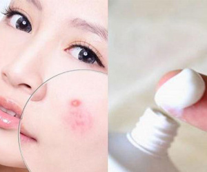 Bất ngờ trước cách trị mụn bọc chẳng tốn bao nhiêu tiền với kem đánh răng!