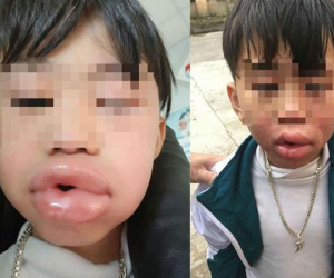 Bé 6 tuổi môi sưng phồng, phải nhập viện cấp cứu sau 3 phút ăn kẹo mua ở cổng trường