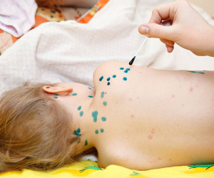 Bệnh thủy đậu và những điều cần biết