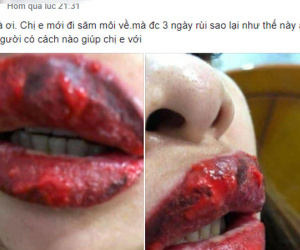 Ham xăm môi căng mọng, cô gái trẻ nước mắt hai hàng nhìn đôi môi sưng tều, 'cháy sém' như quả táo héo