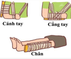 Hướng dẫn sơ cứu đúng cách cho trẻ bị gãy xương