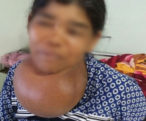 Người phụ nữ mang khối bướu 'khổng lồ' ở cổ suốt 35 năm