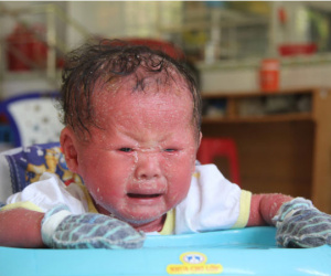 Người đầy vẩy ngứa như da trăn, bé gái 14 tháng tuổi bị bố mẹ bỏ rơi nên không có tiền chữa trị