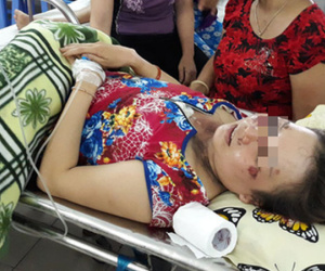 Sét đánh đứt dây chuyền vàng, người đeo cháy cổ