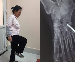 Khó tin, một phụ nữ Hà Nội uống hàng chục kg thuốc giảm đau