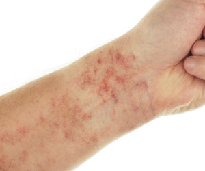 12 dấu hiệu cảnh báo bệnh lupus ban đỏ