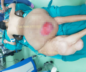 Bác sĩ 'choáng' với khối u nặng 45 kg trên người nam thanh niên