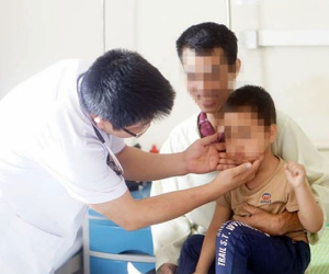 Bé trai 5 tuổi mọc ria mép do lạm dụng corticoid