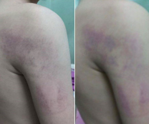 Hà Nội: Phụ huynh tố giáo viên chủ nhiệm đánh con trai lớp 1 bầm tím vì trình bày bài không trôi chảy