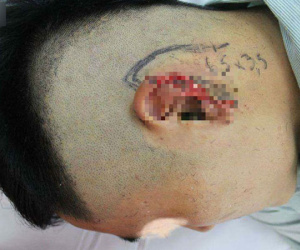 Hà Nội: Thanh niên ngồi nhậu bị bạn nhậu cắt đứt tai