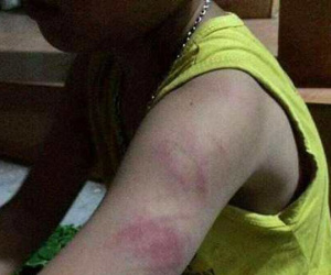 Bé trai lớp 1 không đọc thông, viết thạo bị cô giáo đánh bầm cánh tay