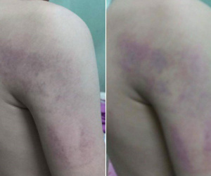 Kỷ luật cảnh cáo cô giáo đánh bầm tím học sinh lớp 1 vì trình bày bài không trôi chảy