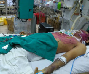 Mắc thủy đậu, chàng trai vạm vỡ bị suy gan, khó qua khỏi