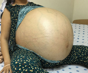 6 giờ ròng rã cứu mạng người phụ nữ mang khối u buồng trứng lớn nhất Việt Nam