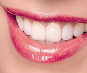 Bọc răng sứ có đẹp vĩnh viễn như quảng cáo?